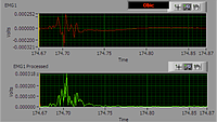 electromyography chart